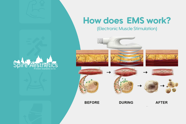 EMS treatment for post pregnancy weight loss treatment Sonning