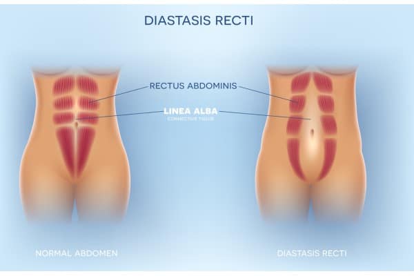 What Non-Surgical Options Are Available for Diastasis Recti Sonning?