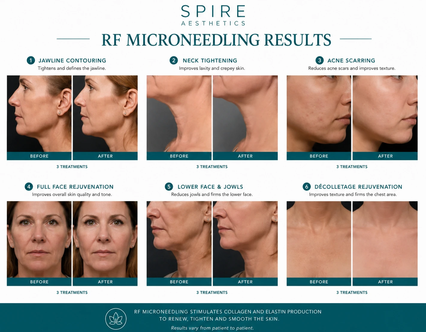 RF Microneedling Skin tightening Sonning results