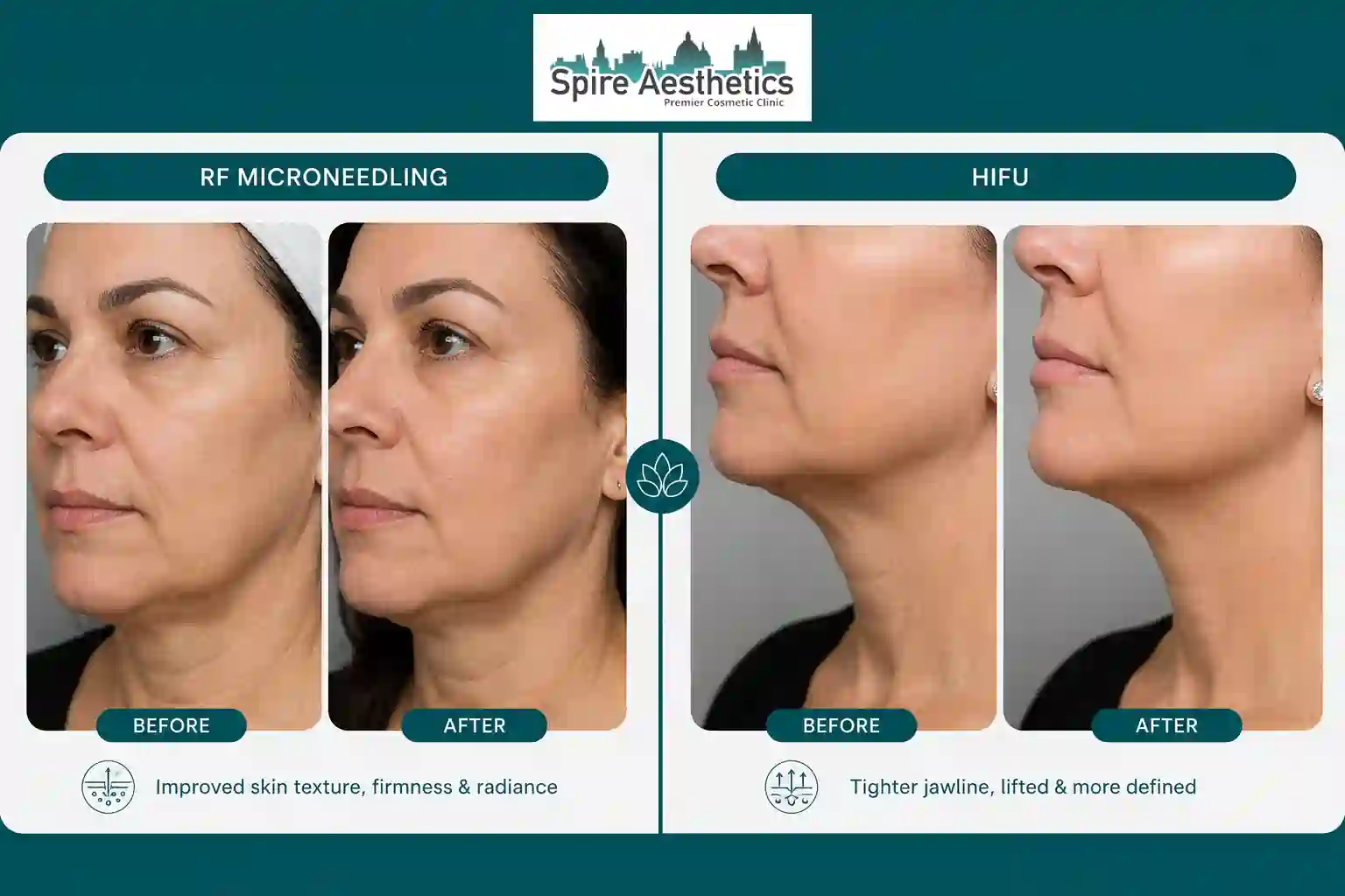 Can RF Microneedling and HIFU Be Combined Sonning?
