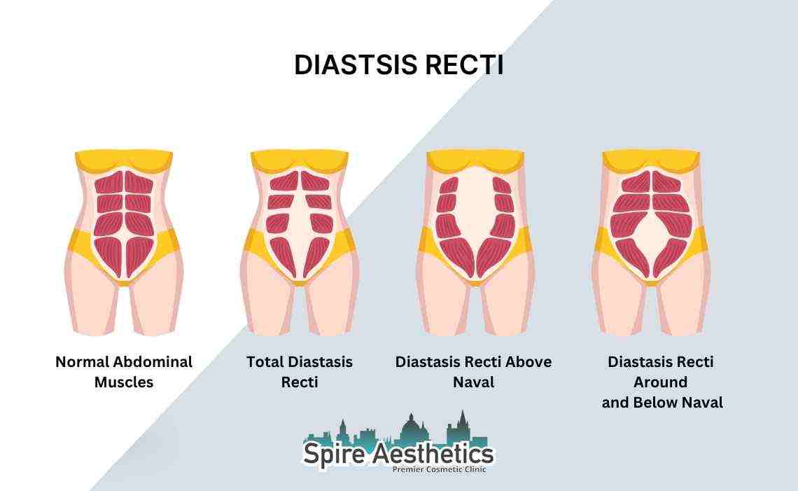 Is Non-Surgical Diastasis Recti Treatment Right for You? Common Concerns Answered Sonning